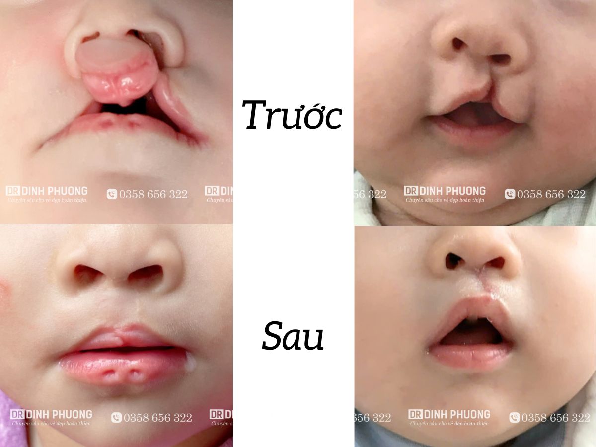 Hình ảnh hai ca phẫu thuật điều trị khe hở môi bởi bác sĩ Phượng