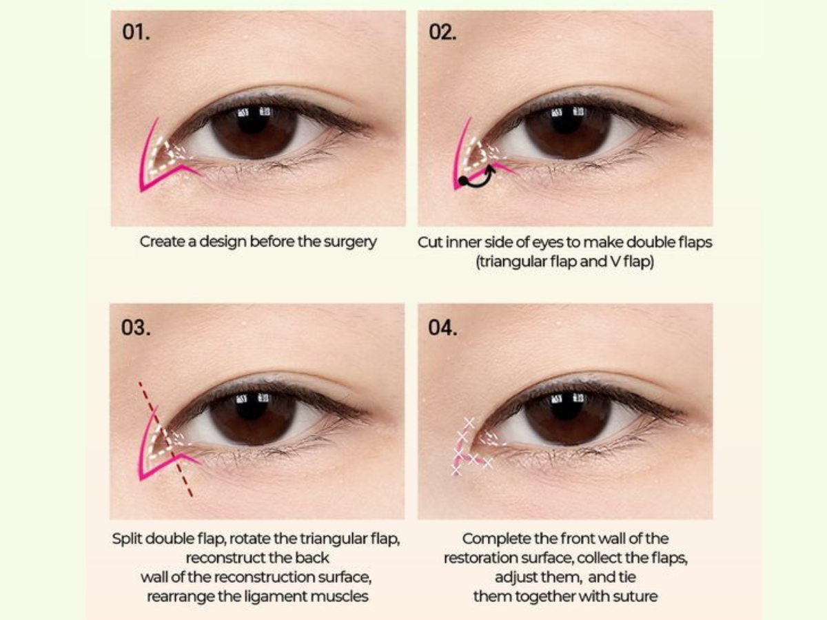 Ví dụ minh họa cho quá trình phẫu thuật mở rộng góc mắt 