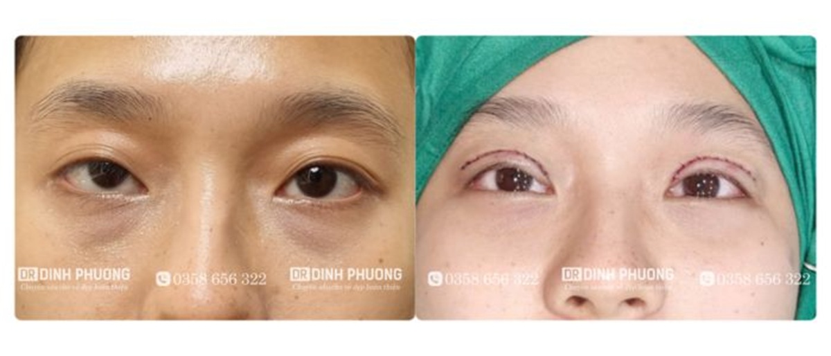 Hình ảnh một số ca phẫu thuật mí đôi do bác sĩ Trần Đình Phượng thực hiện