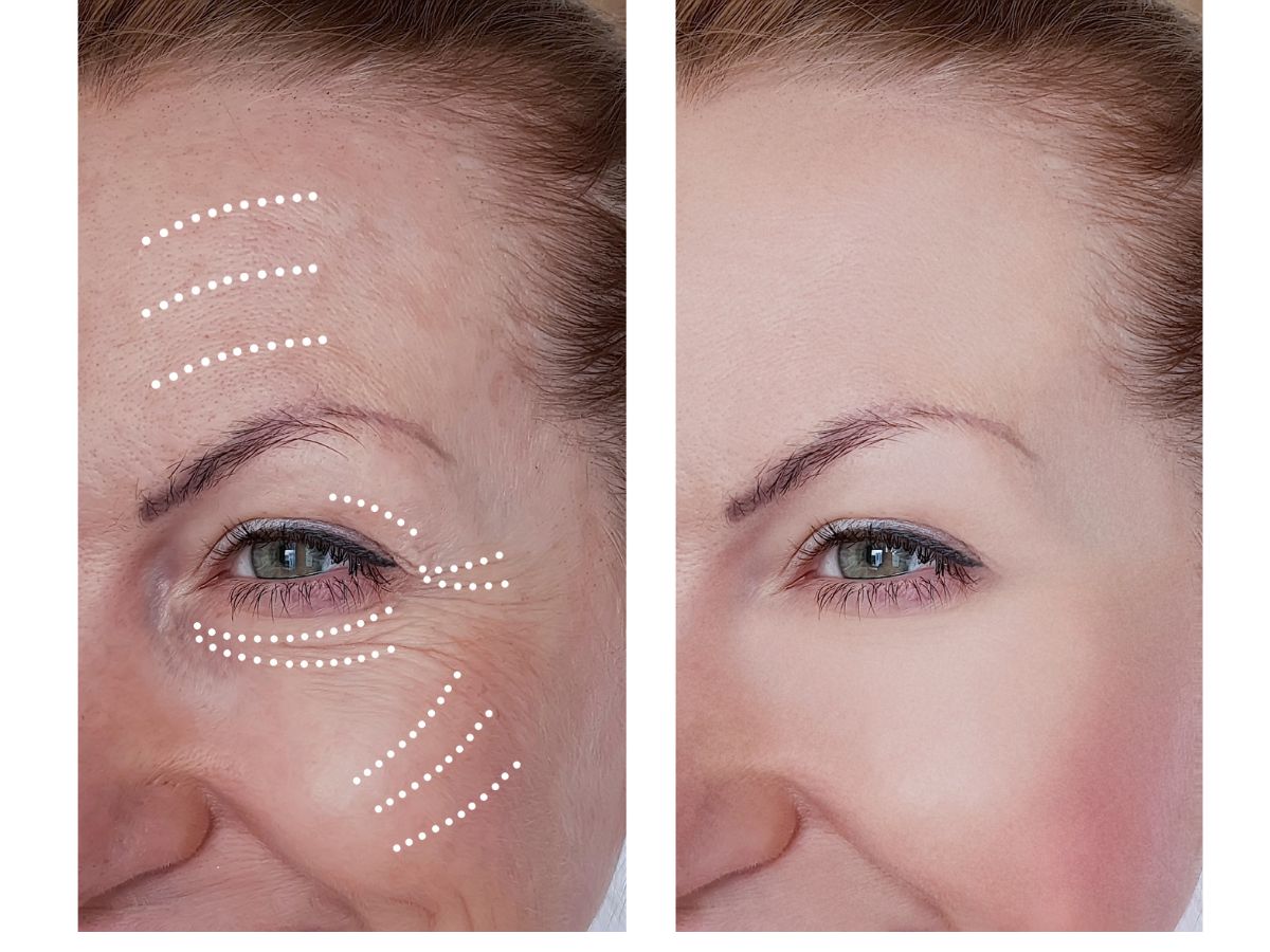 Giải đáp các thắc mắc xoay quanh phương pháp phẫu thuật căng da mặt