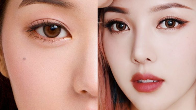 Cắt mí dưới xóa rãnh lệ