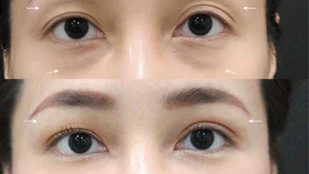 Cấy mỡ hốc mắt