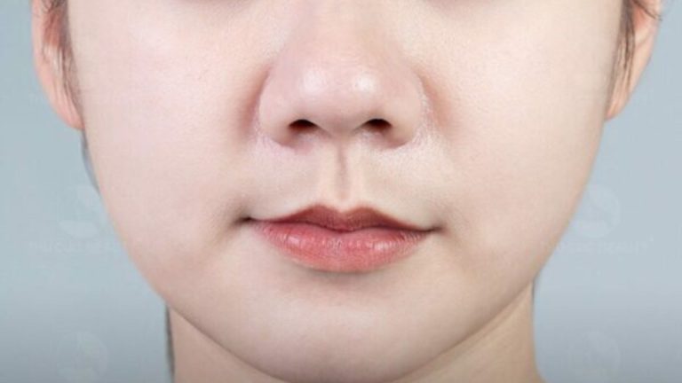 Thu gọn cánh mũi