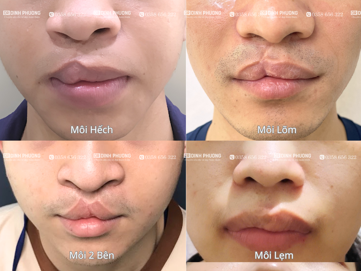 Tạo hình thẩm mỹ môi là gì và có vai trò như thế nào?