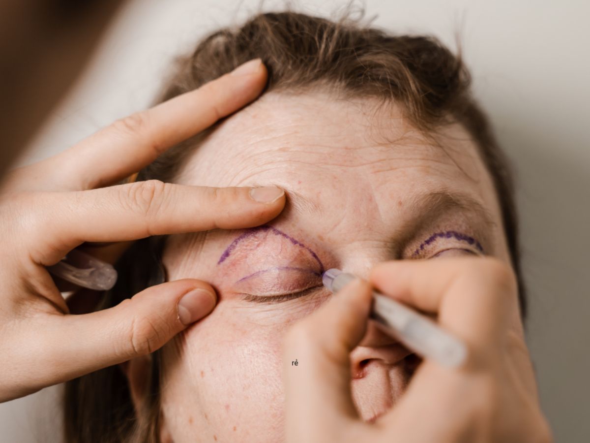 Khắc phục sụp mí mắt do lão hóa bằng kỹ thuật cắt da thừa mí mắt