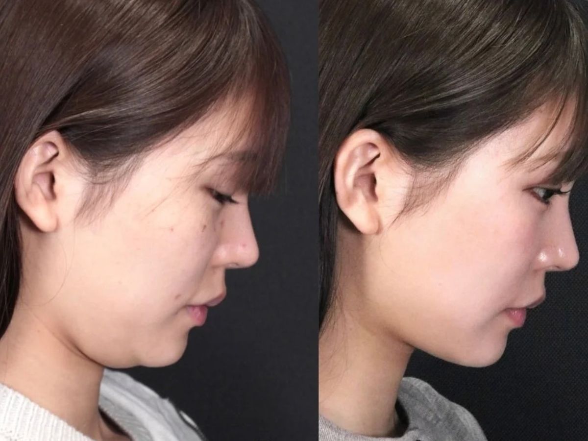 Chi phí thực hiện hút mỡ nọng cằm phụ thuộc vào nhiều yếu tố