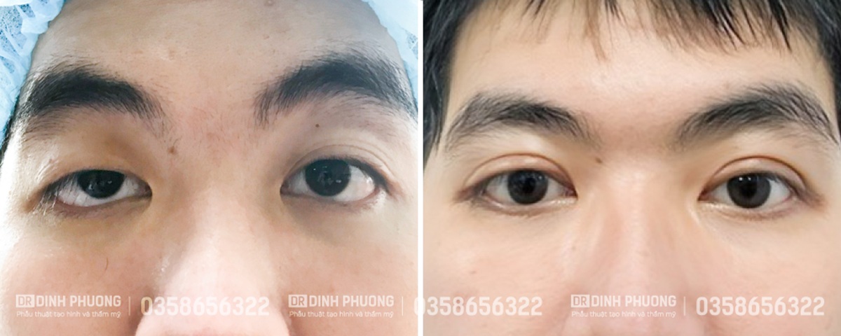 Hình ảnh một số ca phẫu thuật mí đôi do bác sĩ Trần Đình Phượng thực hiện