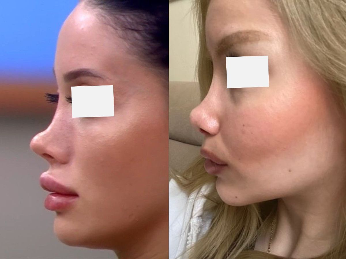 Người có nhiều khuyết điểm về mũi như thấp, tẹt, cánh mũi to