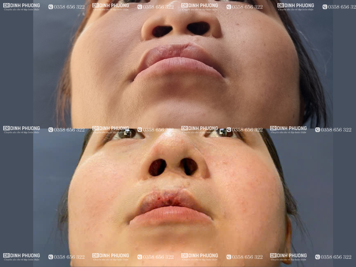 Hình ảnh trước và sau khi phẫu thuật tạo hình thẩm mỹ mũi
