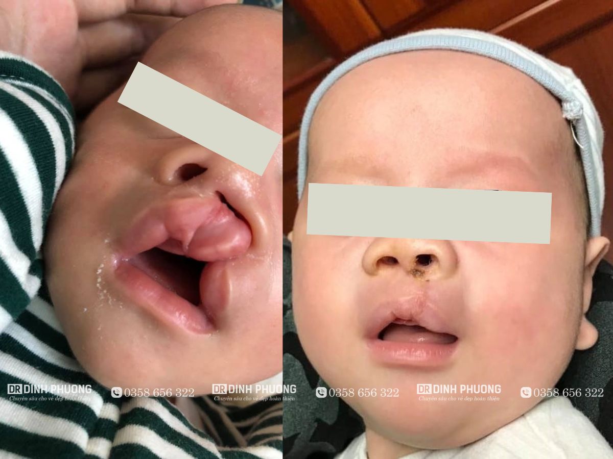 Hình ảnh trước - sau khi phẫu thuật bởi bác sĩ Trần Đình Phượng