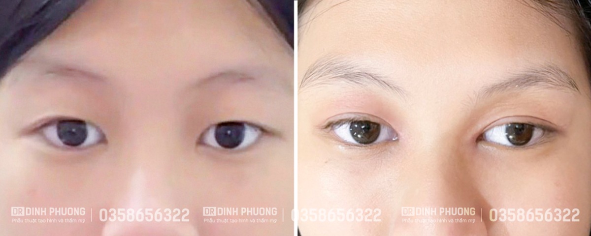 Hình ảnh một số ca phẫu thuật mí đôi do bác sĩ Trần Đình Phượng thực hiện