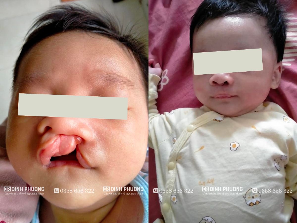 Hình ảnh trước - sau khi phẫu thuật bởi bác sĩ Trần Đình Phượng