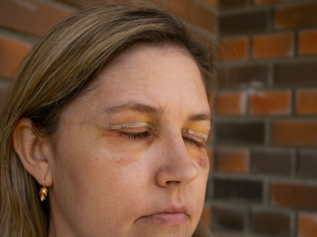 Một số lưu ý sau khi phẫu thuật mí đôi để vết thương nhanh lành và đạt kết quả tự nhiên