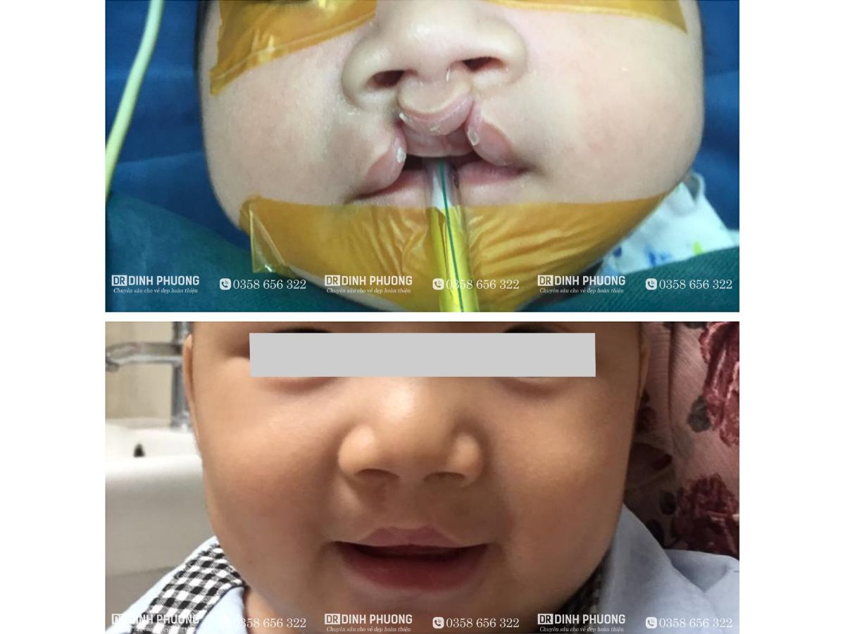 Hình ảnh trước - sau khi phẫu thuật bởi bác sĩ Trần Đình Phượng