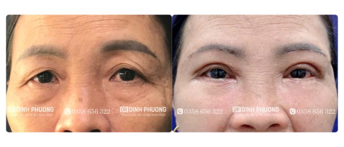 Hình ảnh trước và sau khi điều trị sụp mí tại bác sĩ Trần Đình Phượng