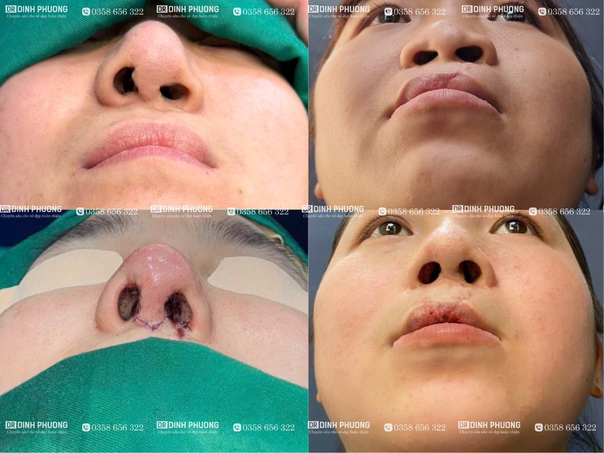 Giải pháp phẫu thuật tạo hình thẩm mỹ mũi 