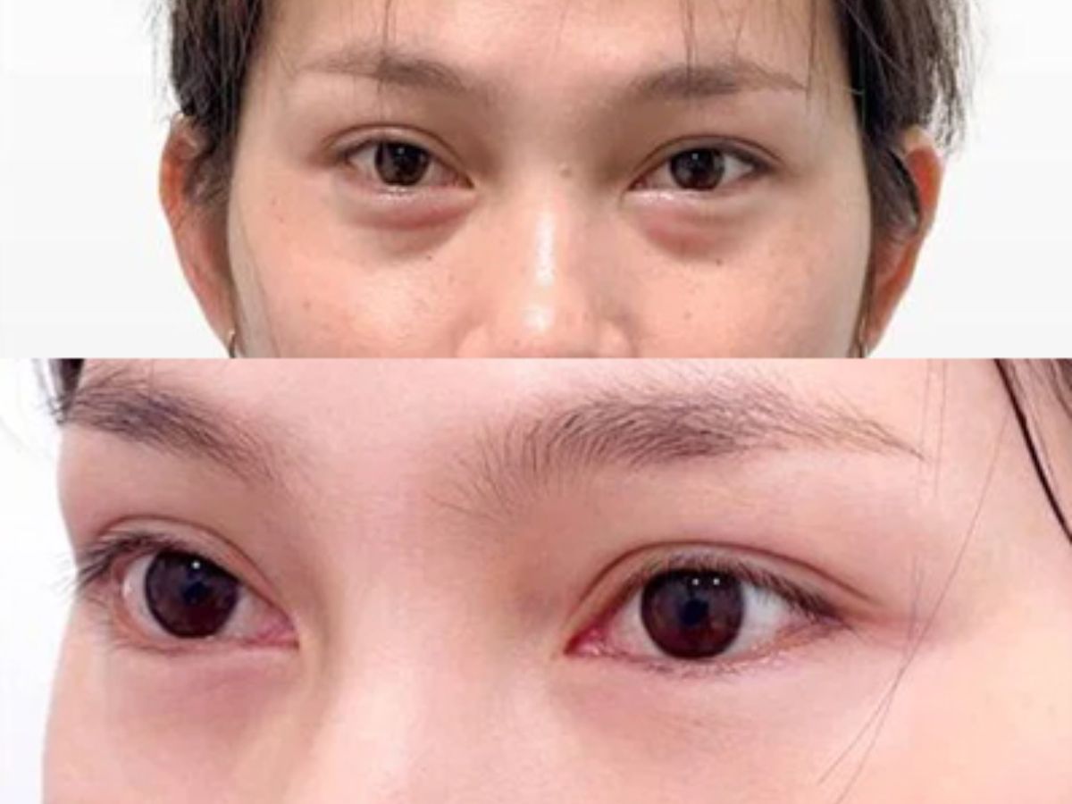 Hình ảnh cắt mí dưới xóa rãnh lệ 