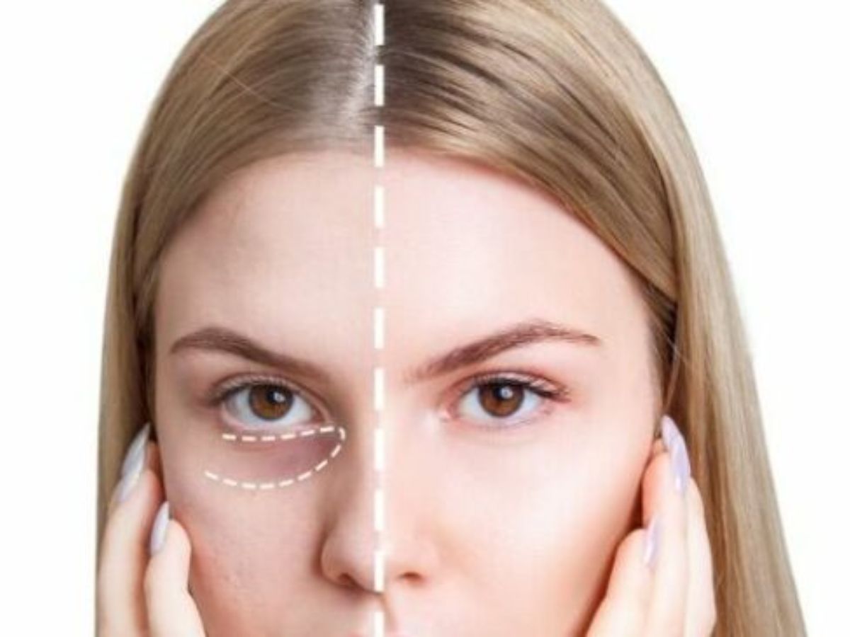 Hình ảnh cấy mỡ hốc mắt