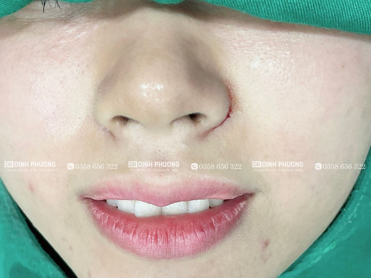 Hình ảnh thu gọn cánh mũi