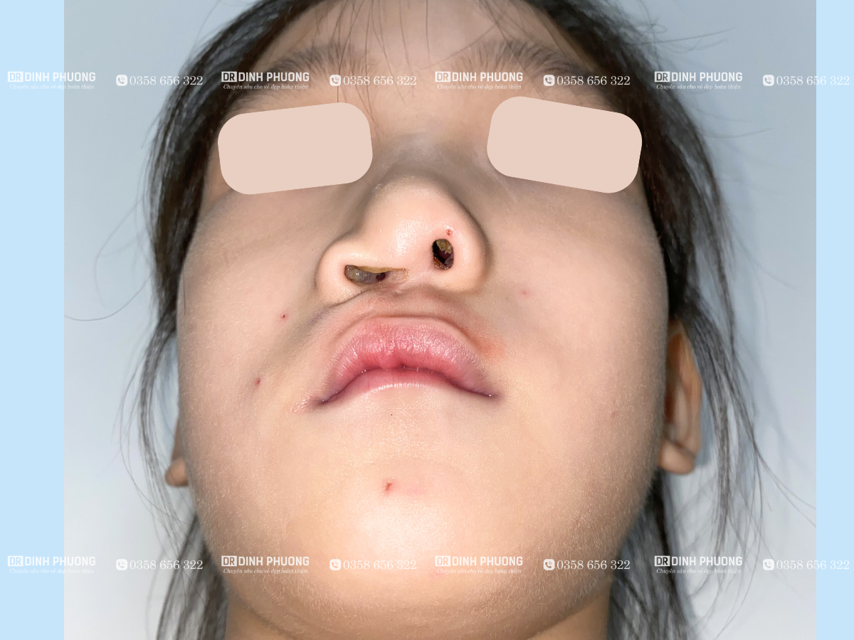 Nguyên nhân mũi bị biến dạng sau phẫu thuật khe hở môi