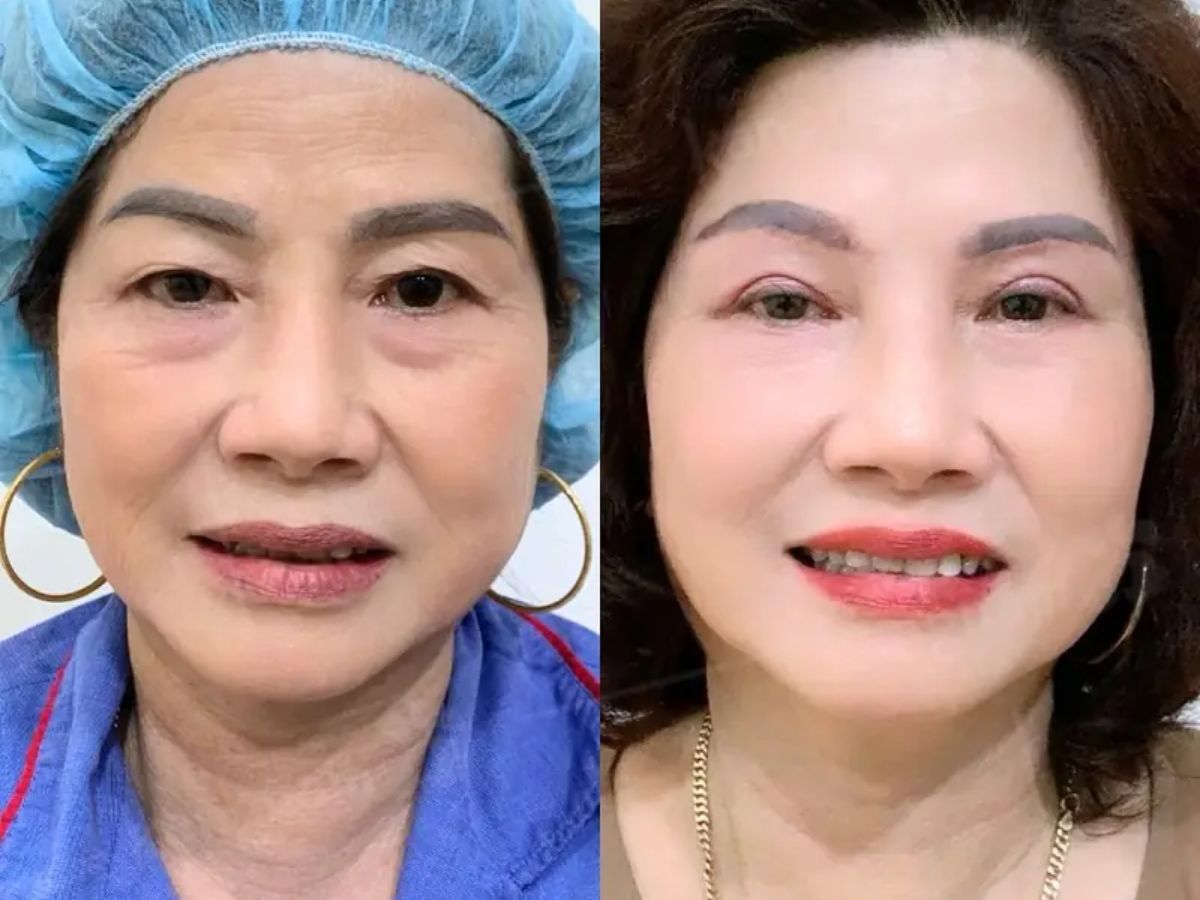 Hình ảnh trước và sau khi thực hiện cắt mí dưới xóa rãnh lệ