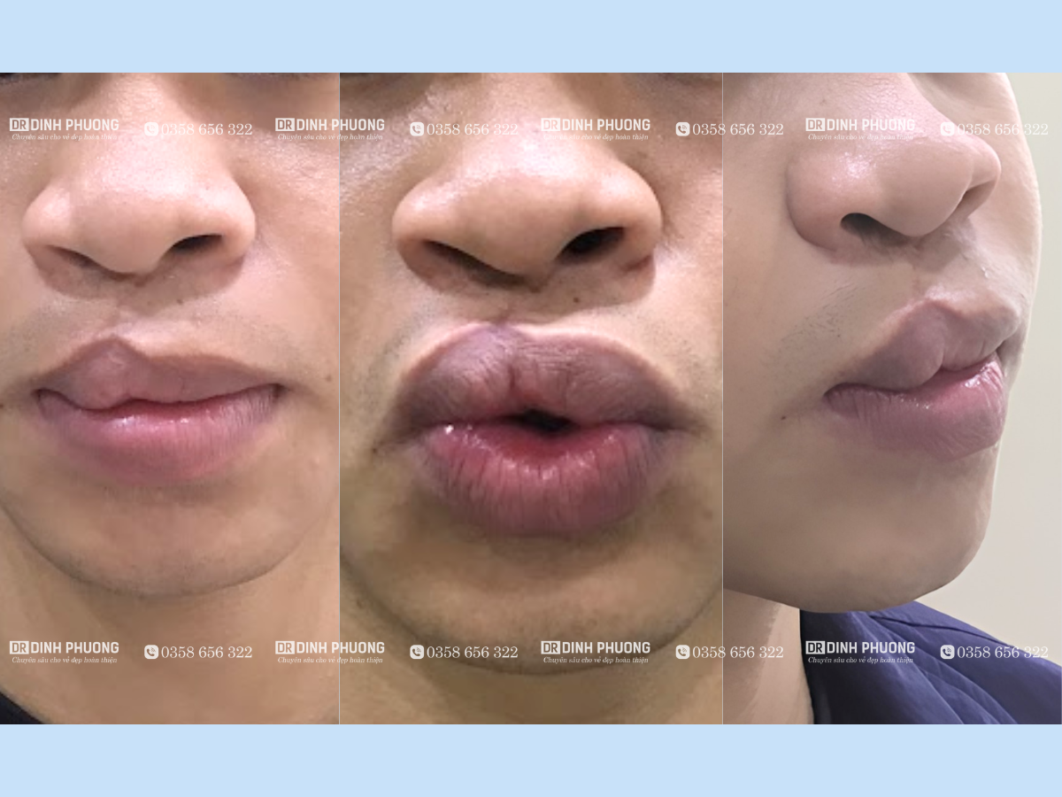 Các biến dạng môi thường gặp sau phẫu thuật khe hở môi hoặc tai nạn