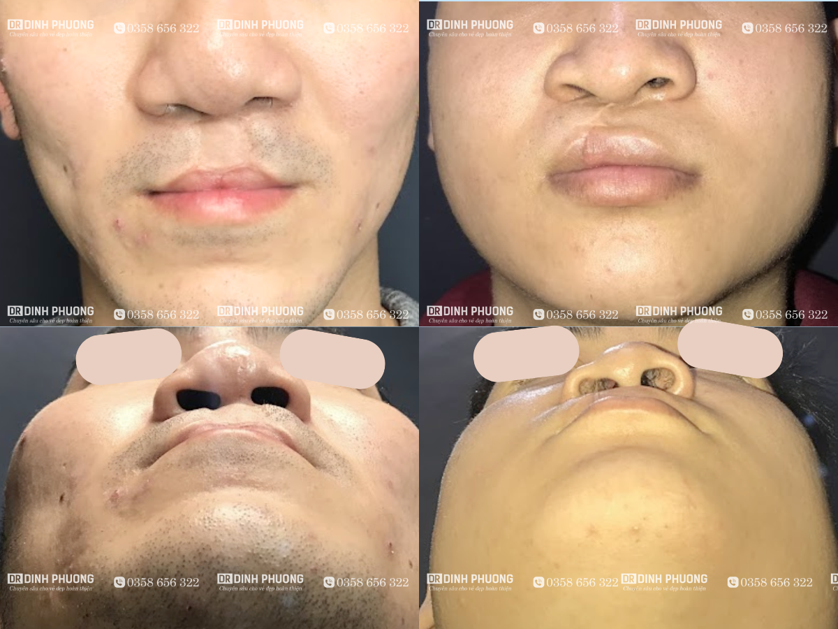 Các biến dạng mũ thường gặp sau phẫu thuật khe hở môi