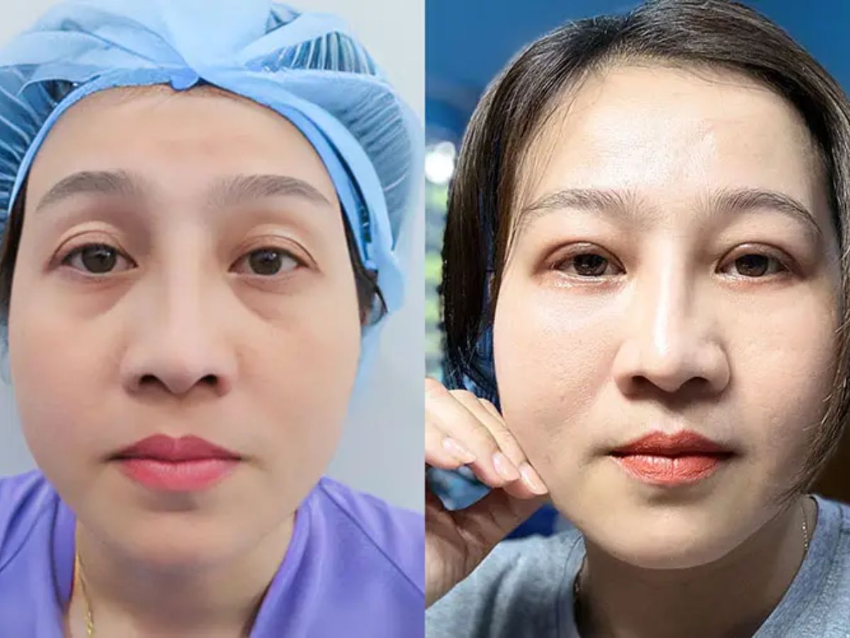 Đối tượng nên và không nên thực hiện cấy mỡ hốc mắt