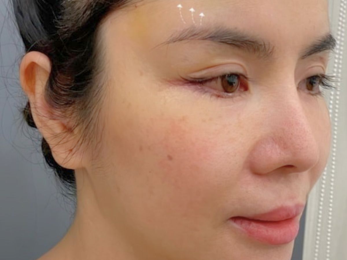 Nâng cung chân mày bằng đường mổ trên cung mày