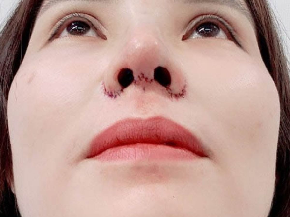 Hình ảnh sau phẫu thuật cắt cánh mũi