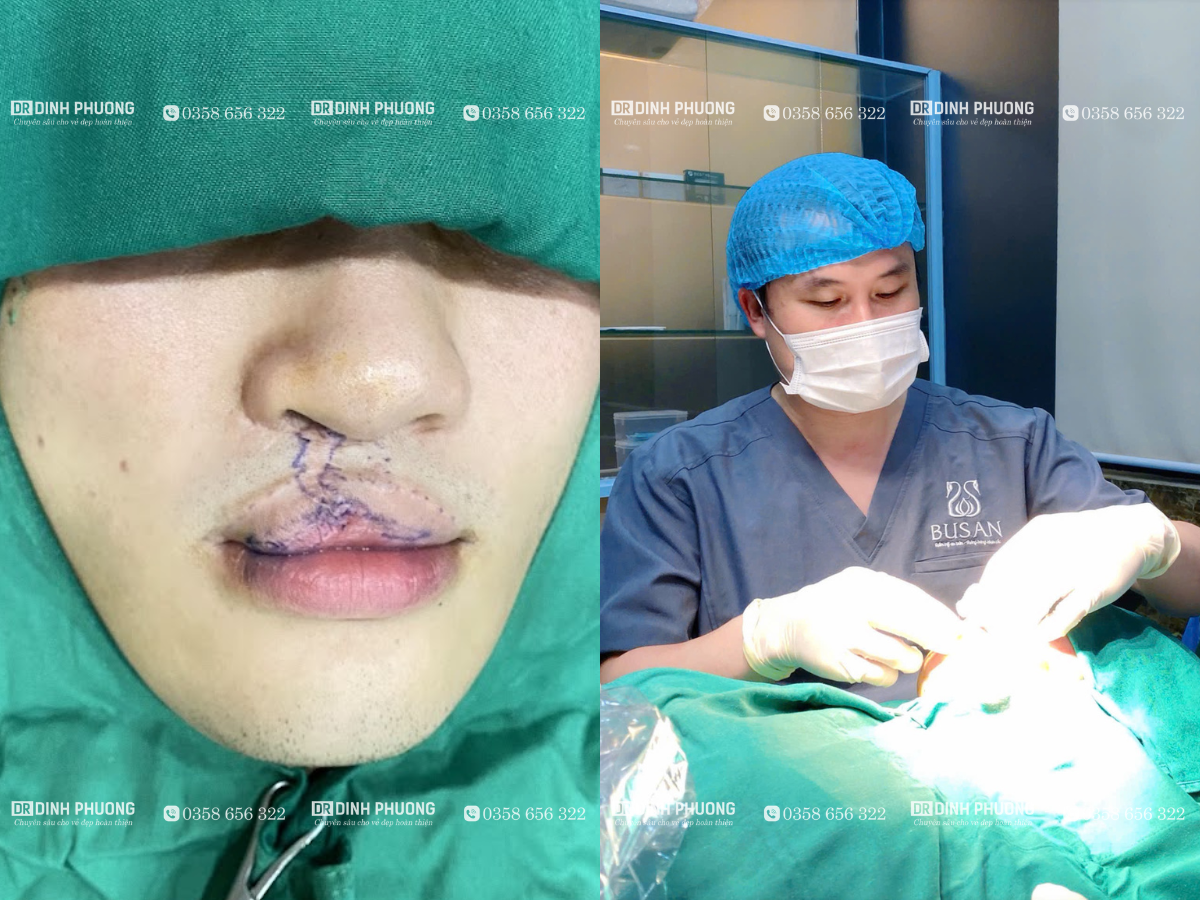 Các bước tiến hành tạo hình thẩm mỹ môi đúng quy định y tế