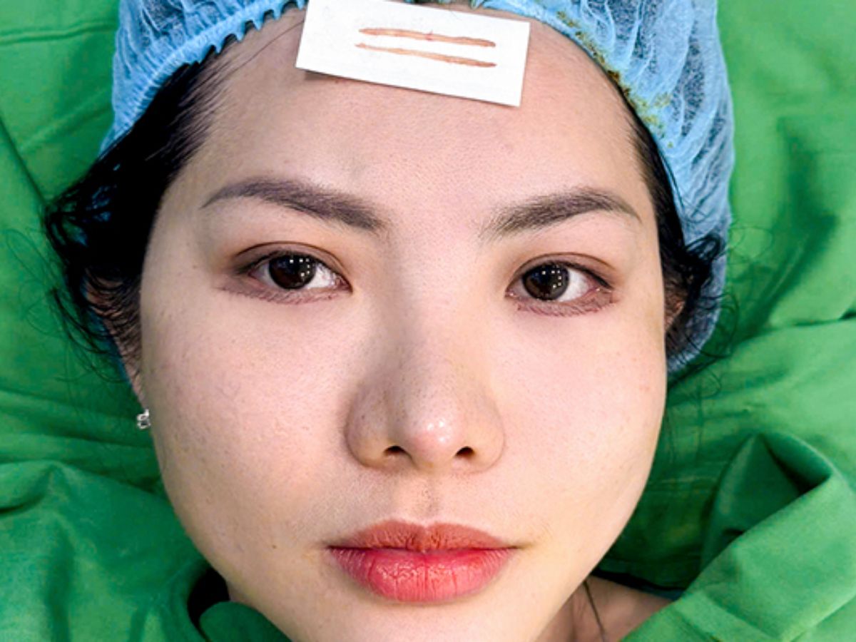 Chi phí cắt mí dưới xóa rãnh lệ