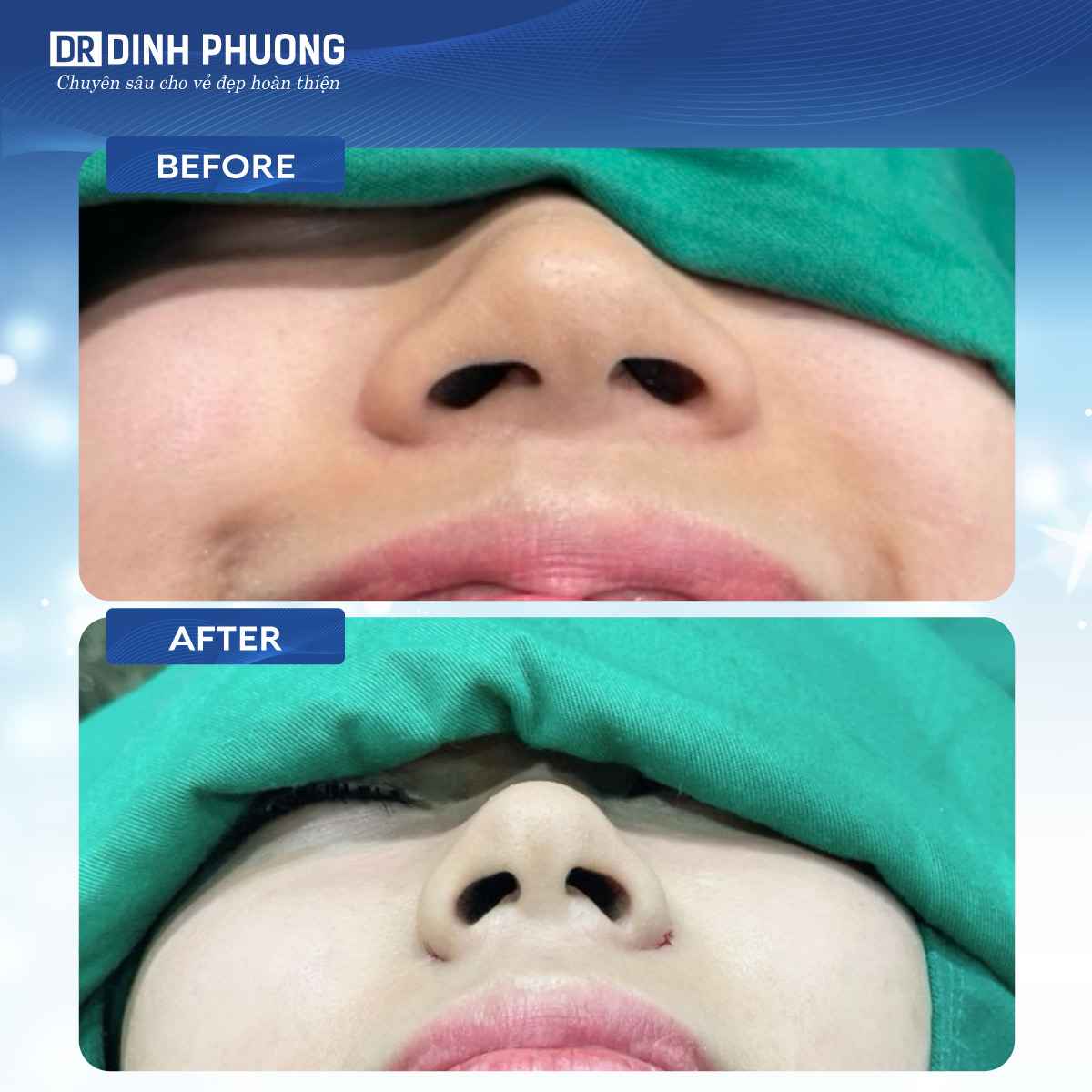 Hình ảnh trước và sau khi thu gọn cánh mũi tại Dr. Đình Phượng