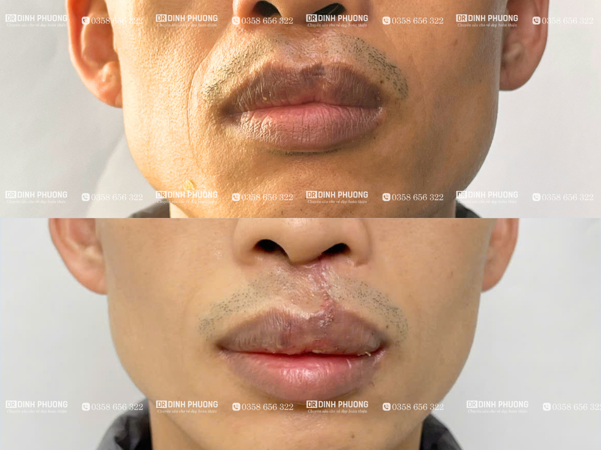 Những câu hỏi thường gặp trong phẫu thuật tạo hình thẩm mỹ môi