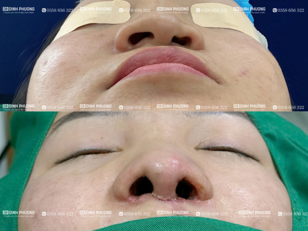 Hình ảnh trước và sau khi phẫu thuật tạo hình thẩm mỹ mũi
