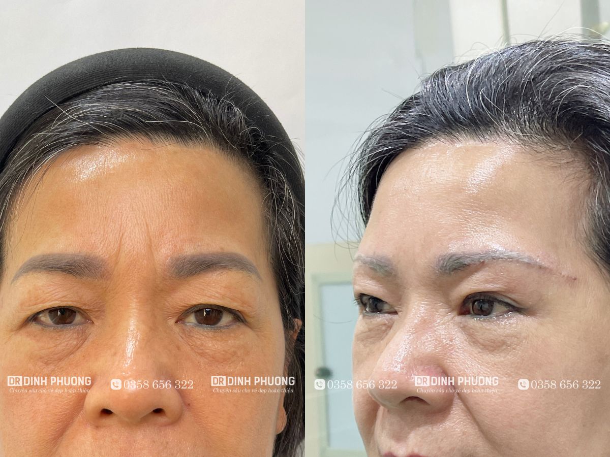 Kết quả sau khi nâng cung chân mày 