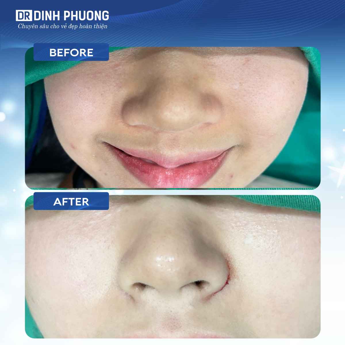 Hình ảnh trước và sau khi thu gọn cánh mũi tại Dr. Đình Phượng