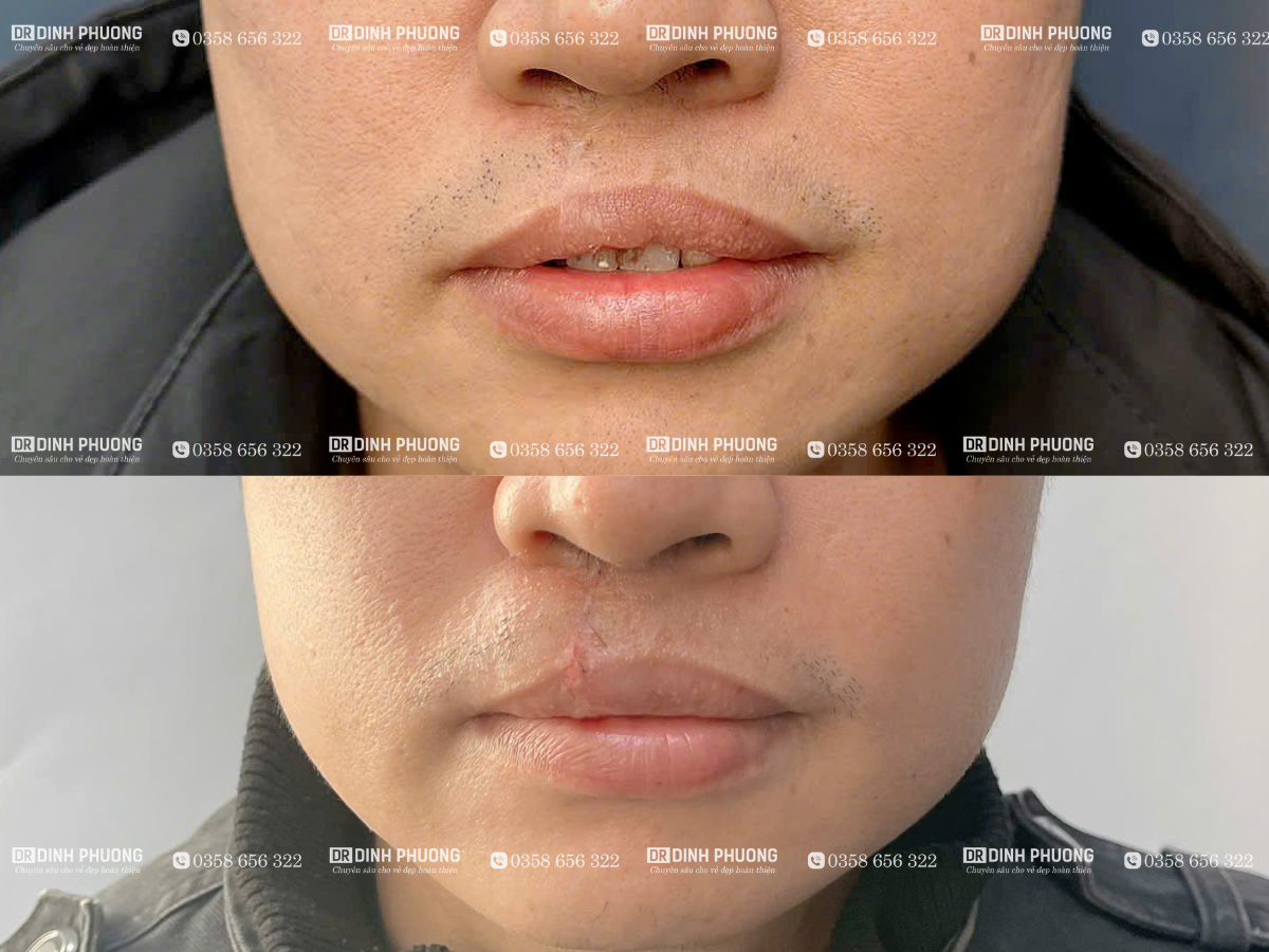 5-Hình ảnh trước - sau phẫu thuật tạo hình thẩm mỹ môi