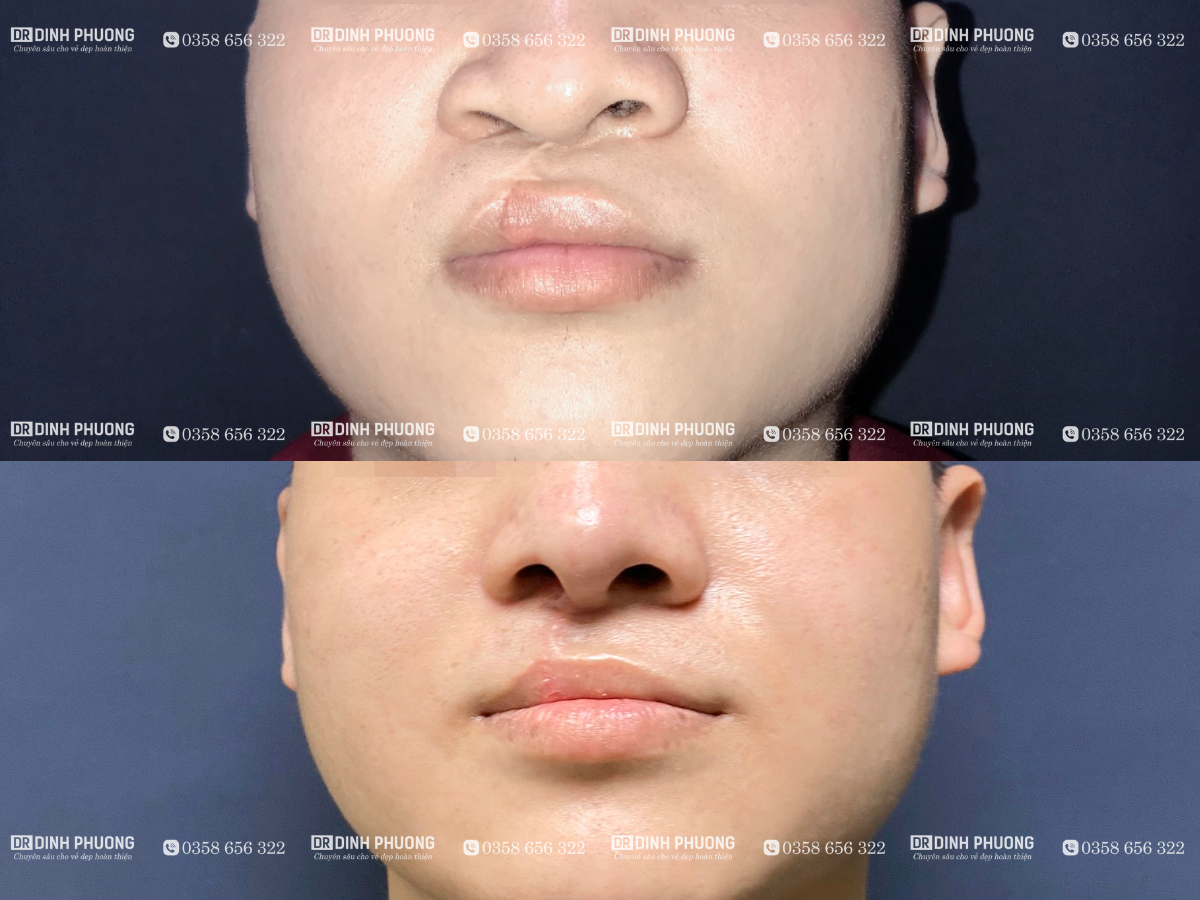 Hình ảnh trước và sau khi phẫu thuật tạo hình thẩm mỹ mũi