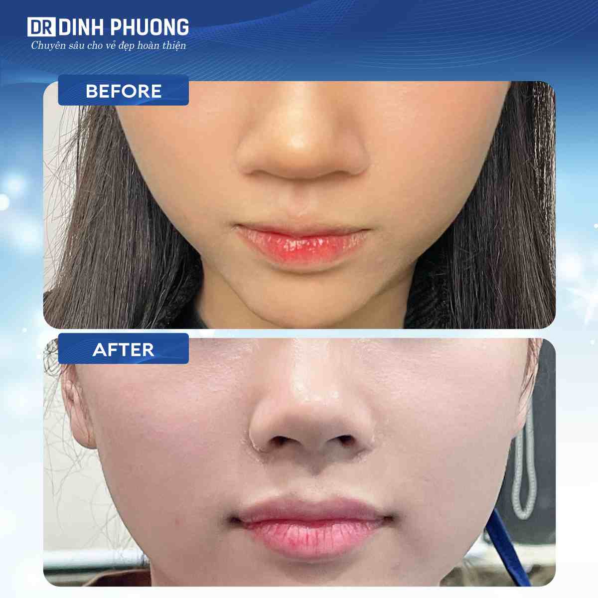 Hình ảnh trước và sau khi thu gọn cánh mũi tại Dr. Đình Phượng