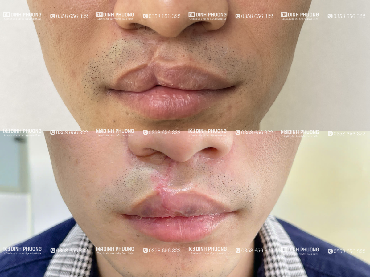 4-Hình ảnh trước - sau phẫu thuật tạo hình thẩm mỹ môi