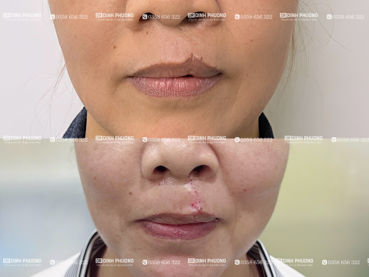 3-Hình ảnh trước - sau phẫu thuật tạo hình thẩm mỹ môi
