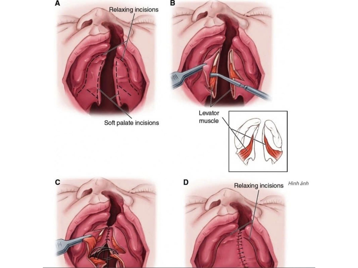 Phương pháp phẫu thuật khe hở vòm mềm