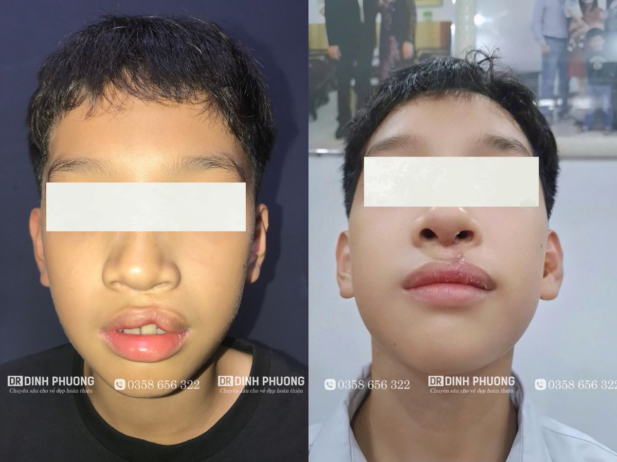 Các biến dạng sau phẫu thuật khe hở môi