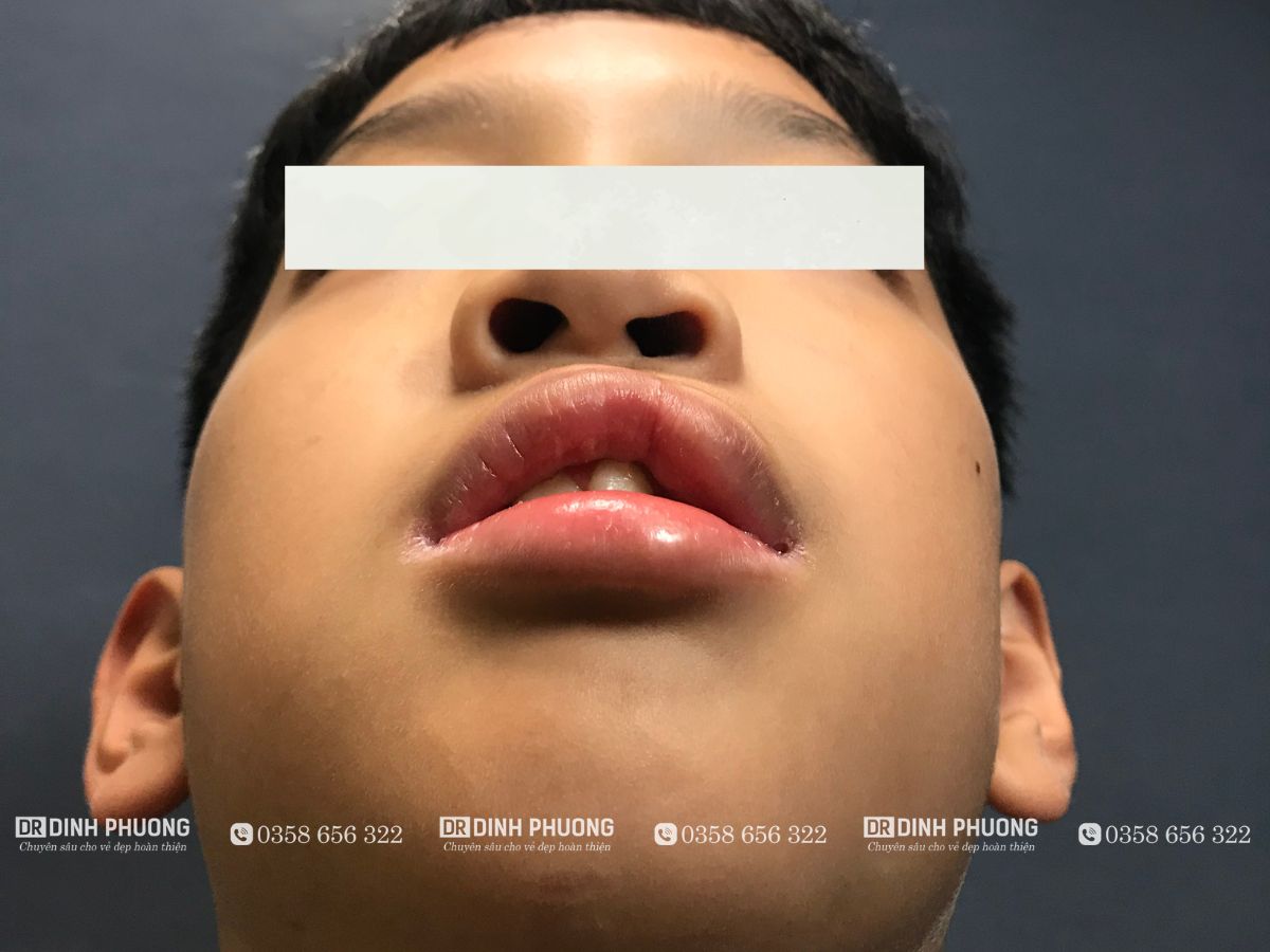 Những kiểu biến dạng mũi phổ biến cần can thiệp tạo hình thẩm mỹ