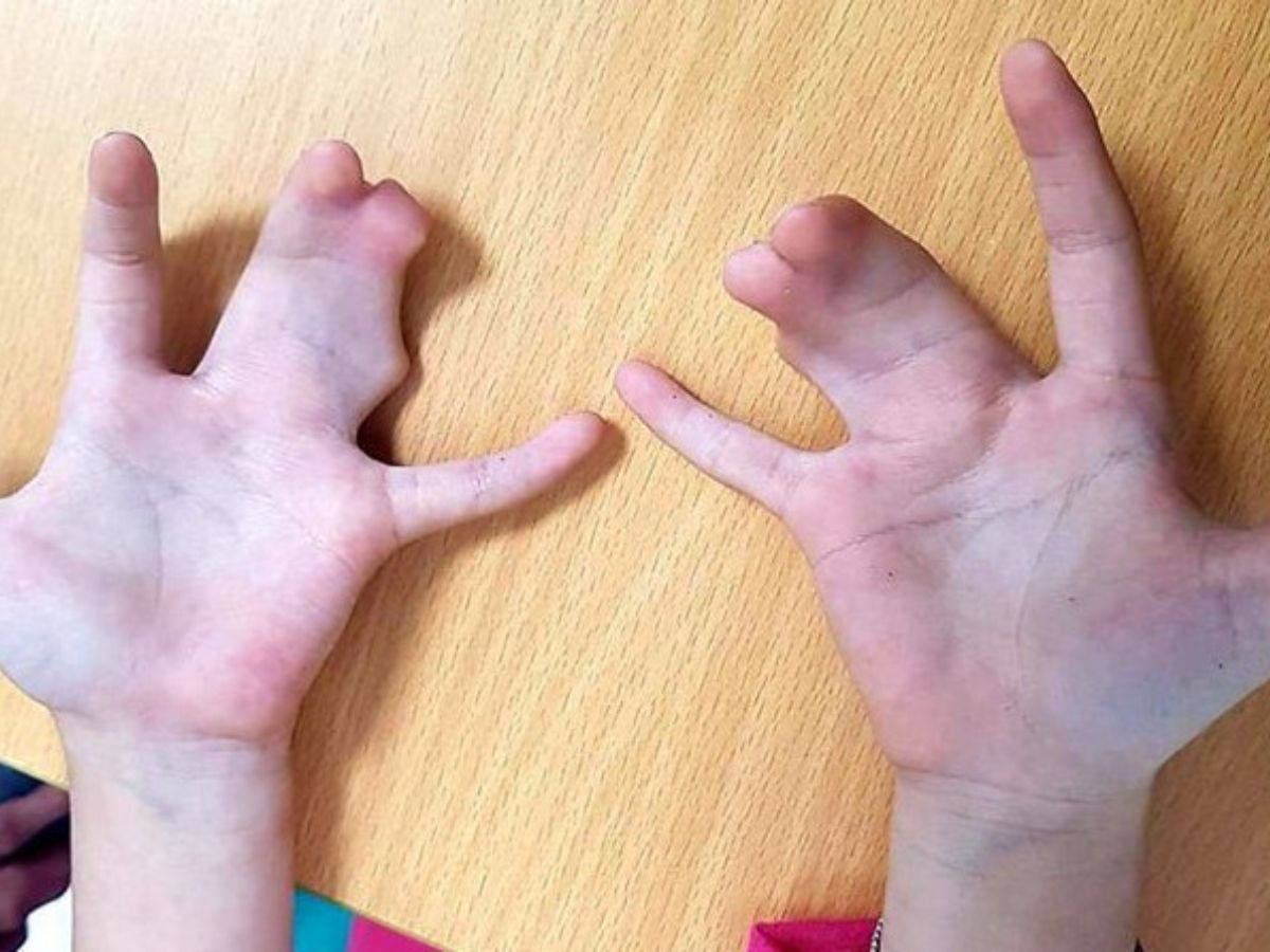 Các yếu tố gây ra dị tật dính ngón tay