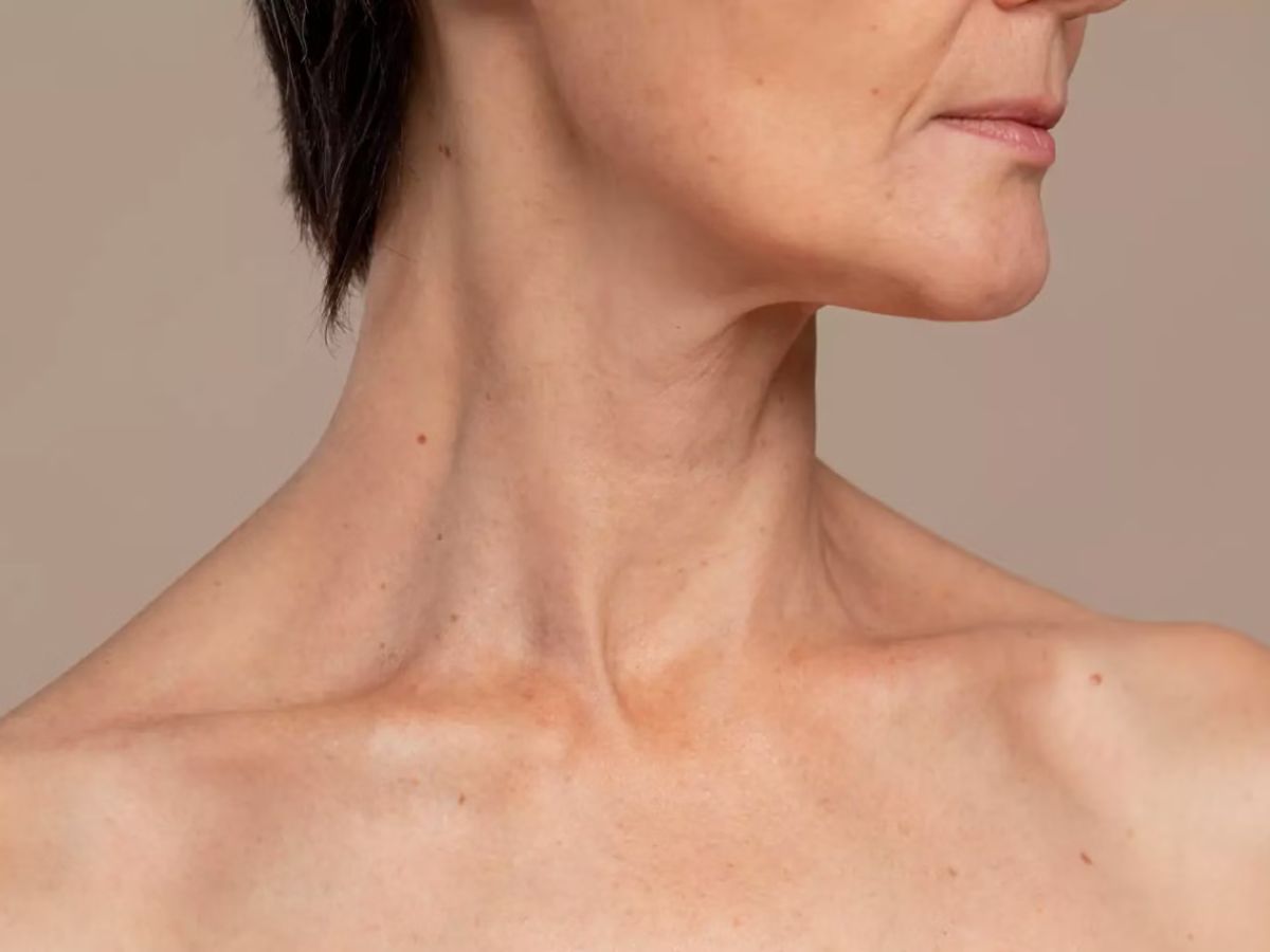 Trẻ hóa vùng cổ bằng phẫu thuật căng da