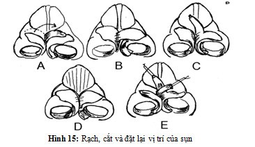 Kỹ thuật cắt, dịch chuyển và ghép sụn cánh mũi
