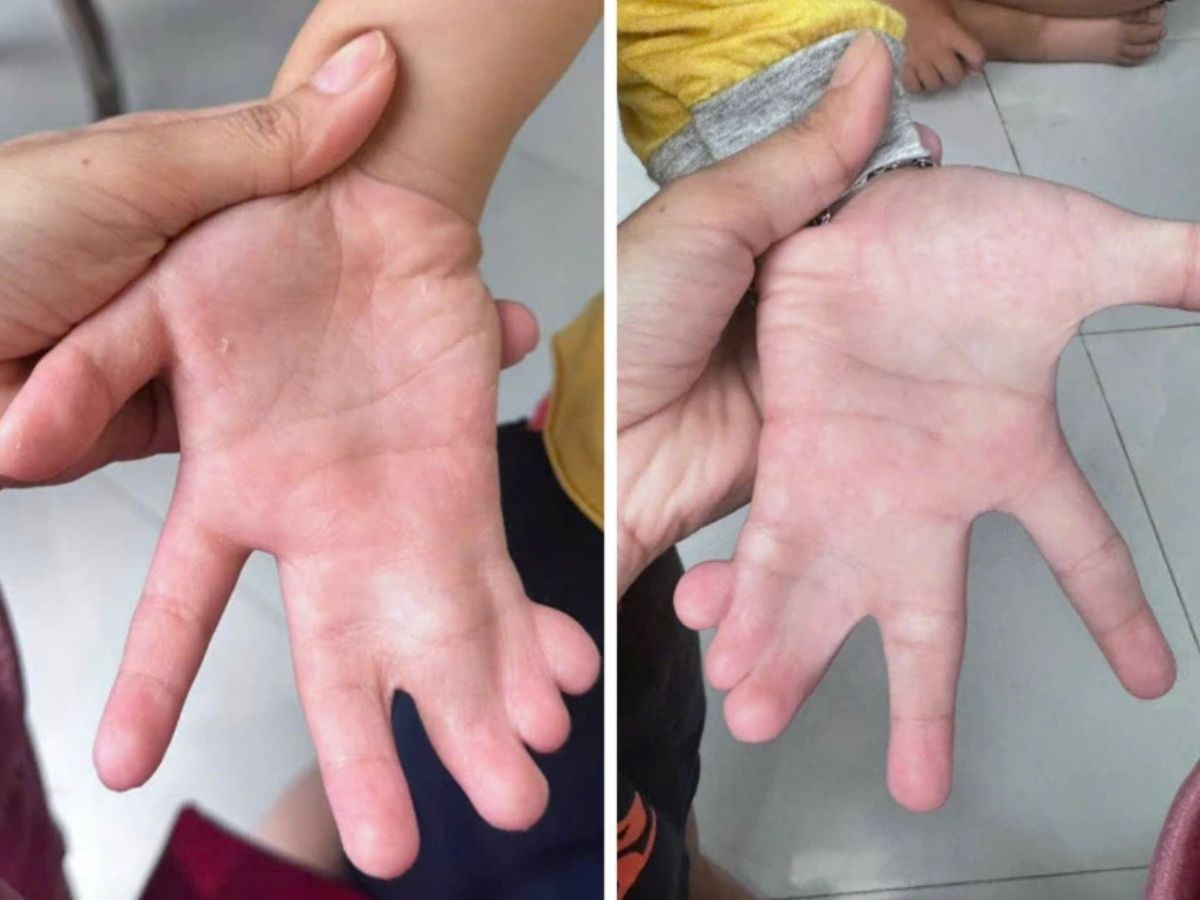 Dị tật dính ngón tay có đáng lo ngại không?