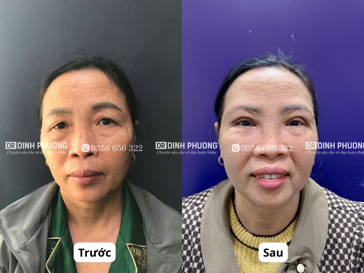 Hình ảnh trước và sau khi cắt da thừa mí mắt